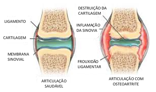 osteoartrite